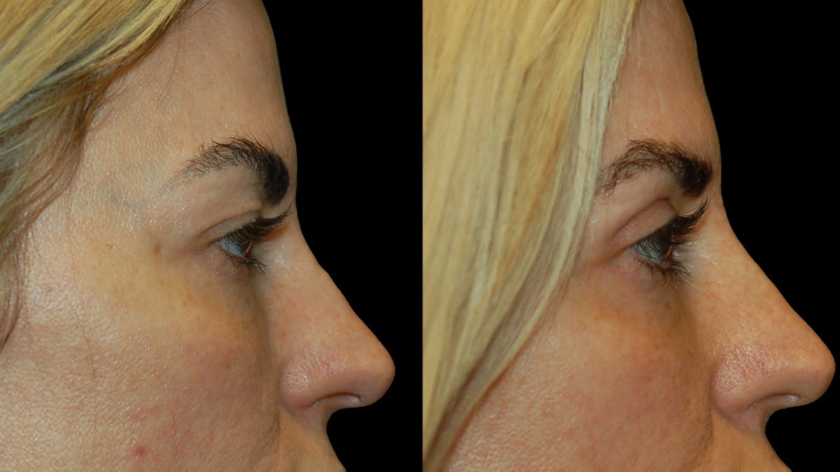 Upper Eyelid Surgery Before & After Gallery - Patient 130707 - Image 10