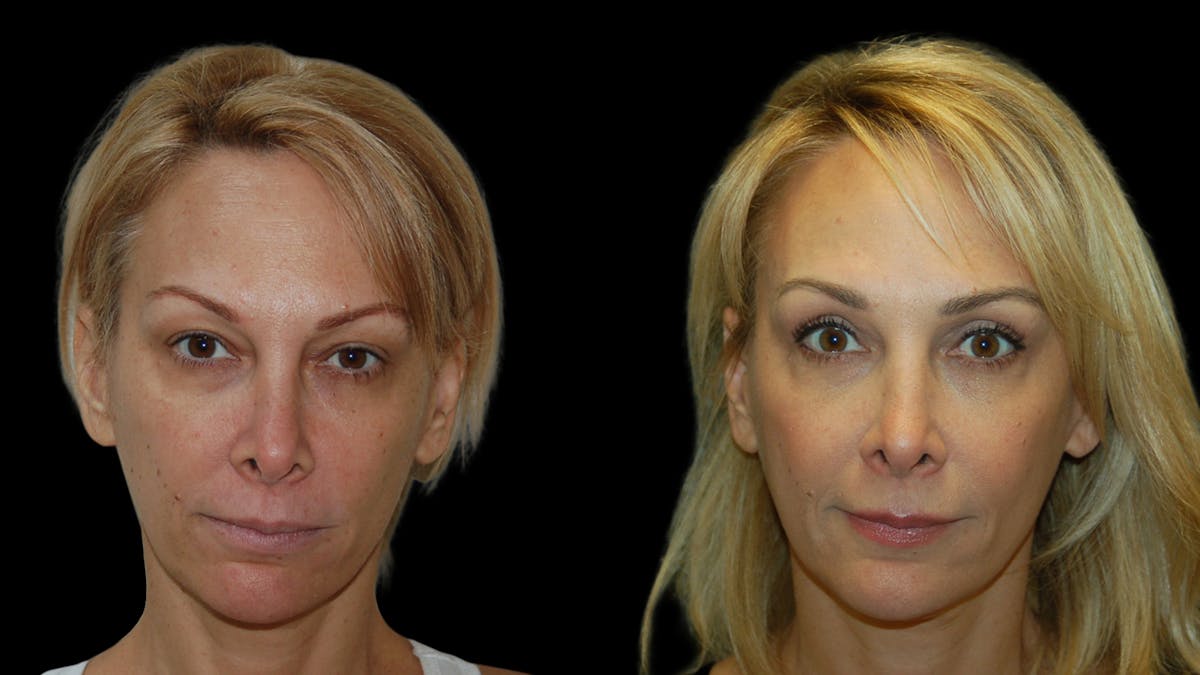 Upper Eyelid Surgery Before & After Gallery - Patient 232544 - Image 1