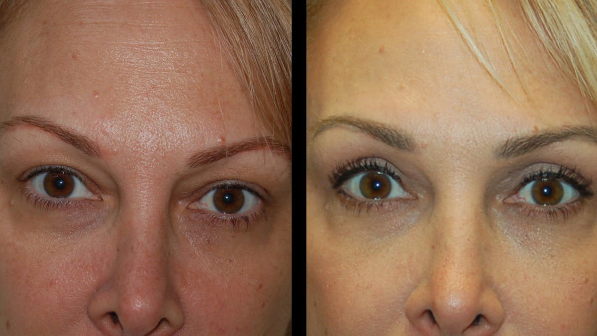 Upper Eyelid Surgery Before & After Gallery - Patient 232544 - Image 6