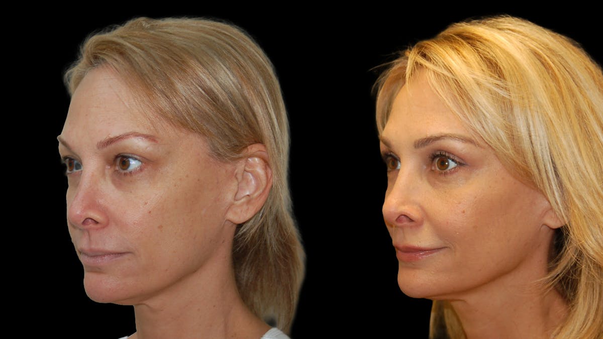 Upper Eyelid Surgery Before & After Gallery - Patient 232544 - Image 2