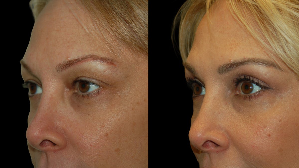 Upper Eyelid Surgery Before & After Gallery - Patient 232544 - Image 7