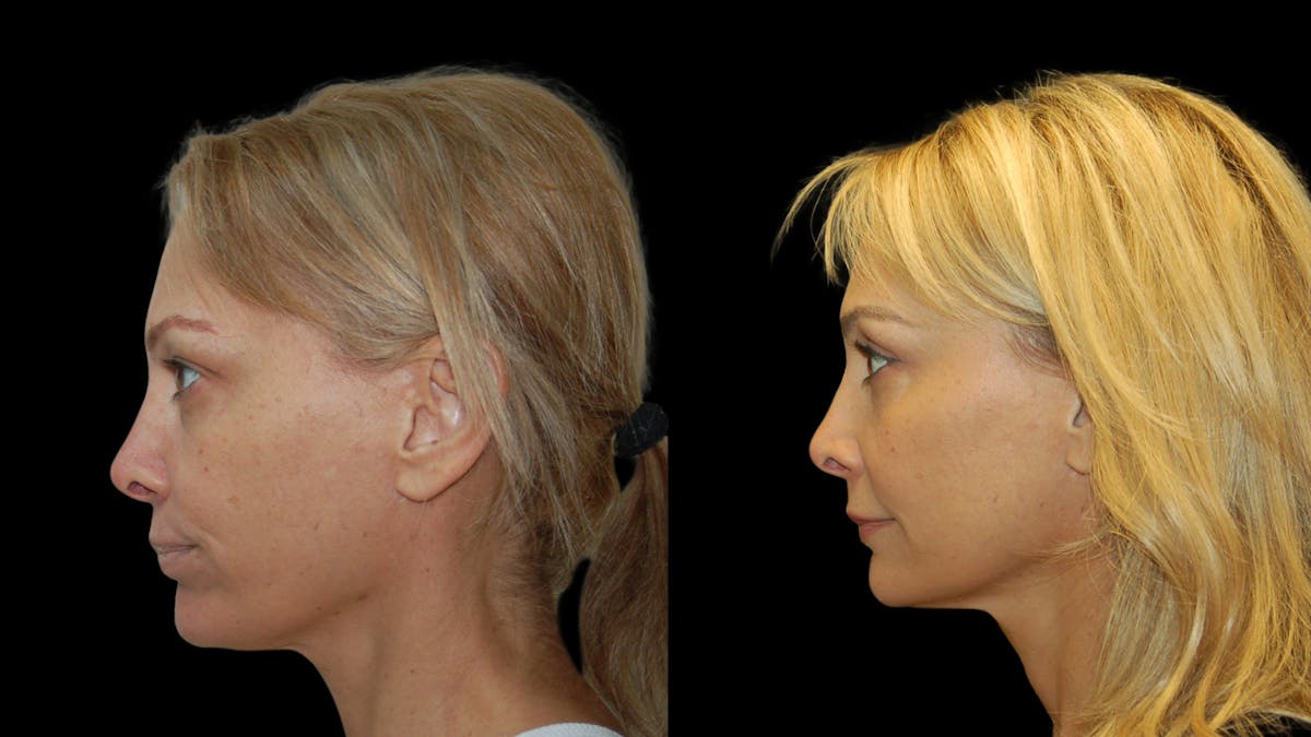Upper Eyelid Surgery Before & After Gallery - Patient 232544 - Image 3