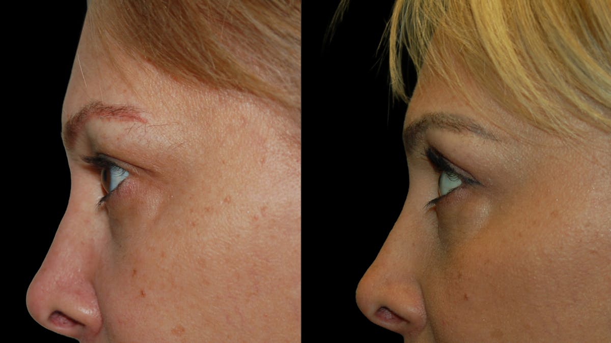 Upper Eyelid Surgery Before & After Gallery - Patient 232544 - Image 8