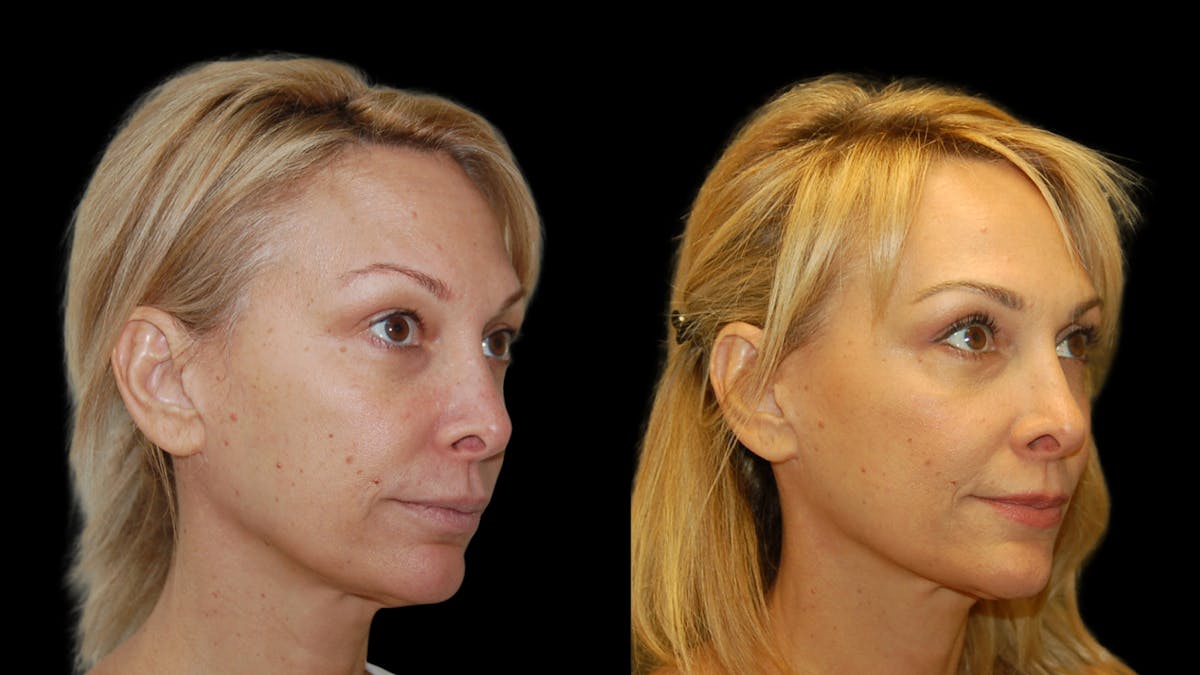 Upper Eyelid Surgery Before & After Gallery - Patient 232544 - Image 4