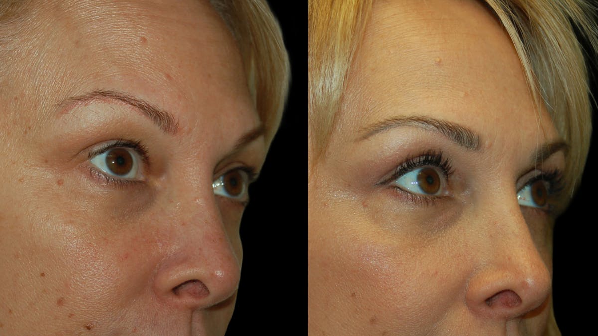 Upper Eyelid Surgery Before & After Gallery - Patient 232544 - Image 9