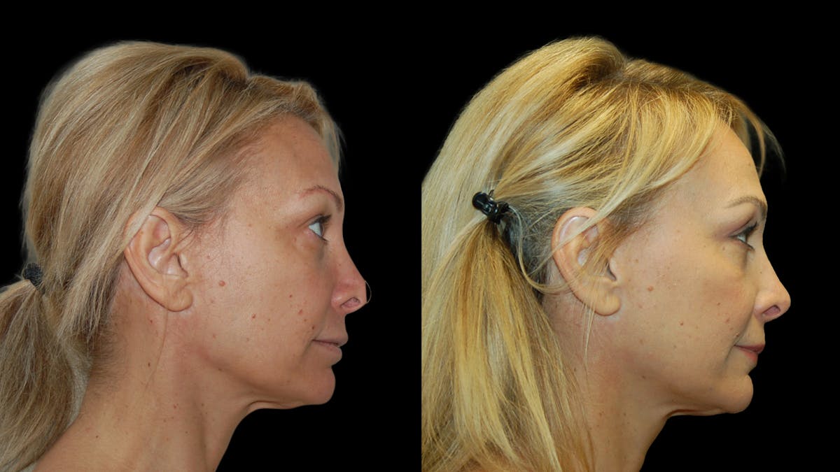 Upper Eyelid Surgery Before & After Gallery - Patient 232544 - Image 5