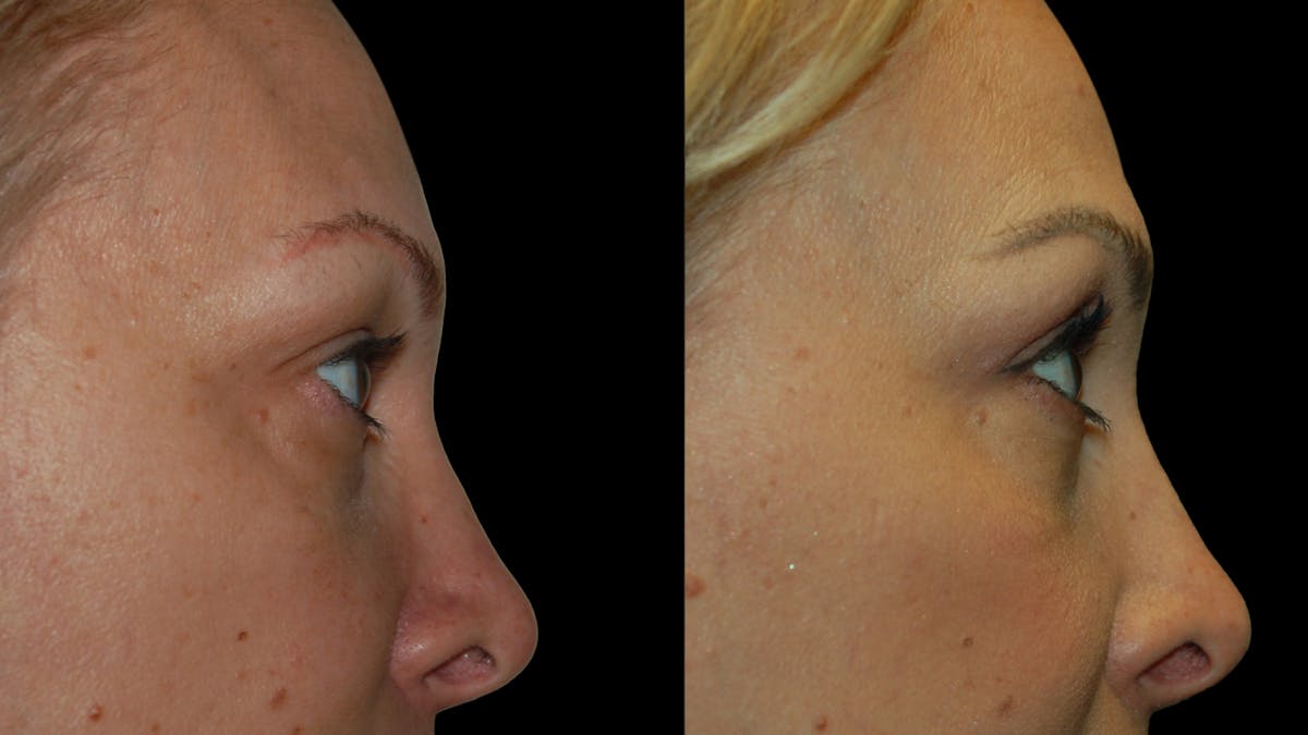 Upper Eyelid Surgery Before & After Gallery - Patient 232544 - Image 10
