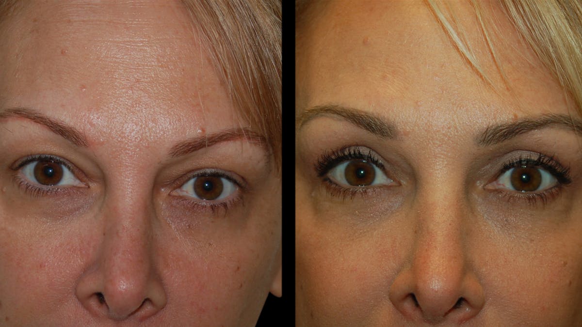Upper Eyelid Surgery Before & After Gallery - Patient 232544 - Image 11
