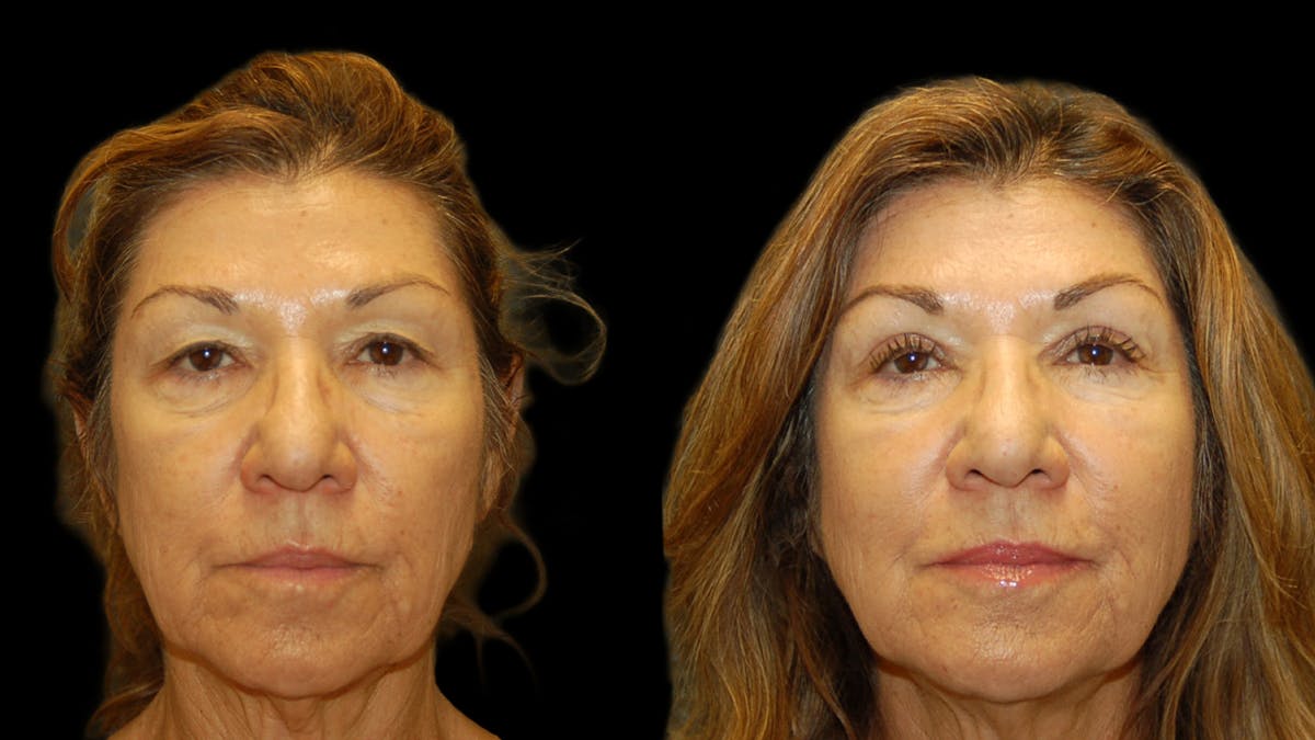 Upper Eyelid Surgery Before & After Gallery - Patient 404975 - Image 1