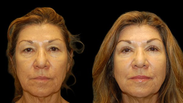 Upper Eyelid Surgery Before & After Gallery - Patient 404975 - Image 1