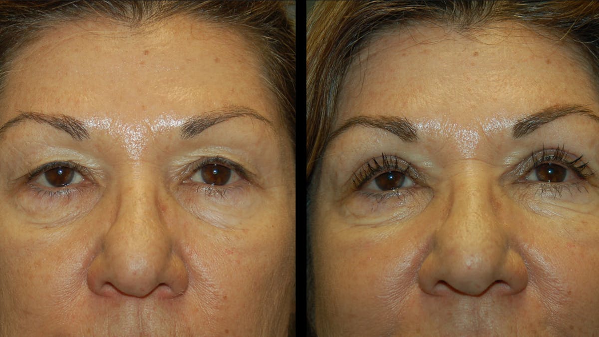 Upper Eyelid Surgery Before & After Gallery - Patient 404975 - Image 2