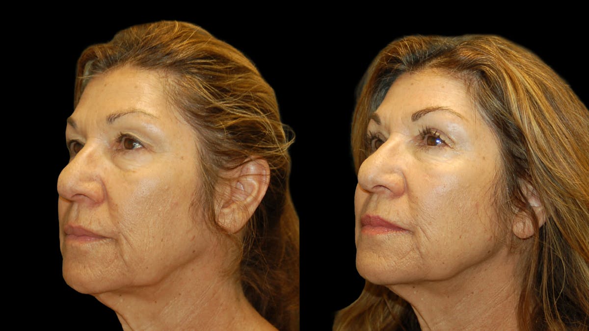 Upper Eyelid Surgery Before & After Gallery - Patient 404975 - Image 3