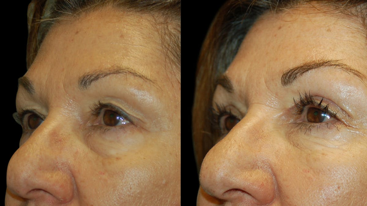 Upper Eyelid Surgery Before & After Gallery - Patient 404975 - Image 4