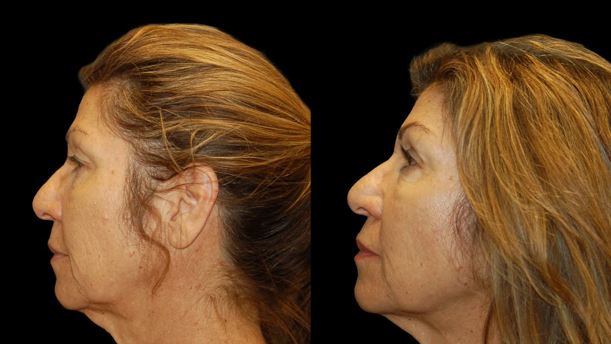 Upper Eyelid Surgery Before & After Gallery - Patient 404975 - Image 5