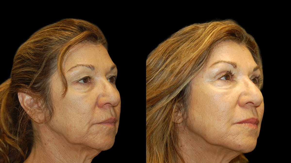 Upper Eyelid Surgery Before & After Gallery - Patient 404975 - Image 6
