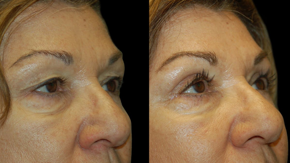 Upper Eyelid Surgery Before & After Gallery - Patient 404975 - Image 7