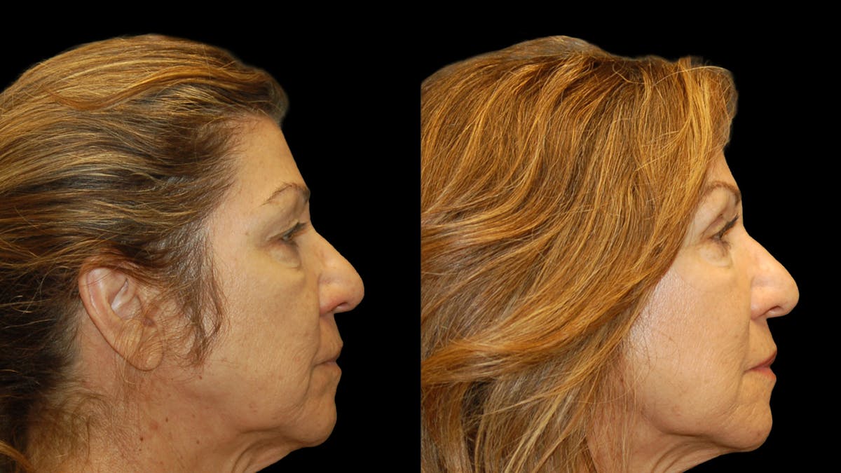 Upper Eyelid Surgery Before & After Gallery - Patient 404975 - Image 8