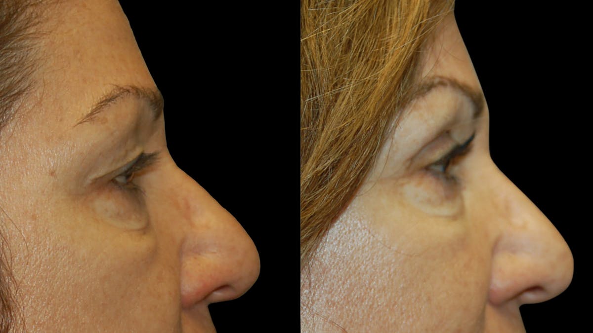 Upper Eyelid Surgery Before & After Gallery - Patient 404975 - Image 9