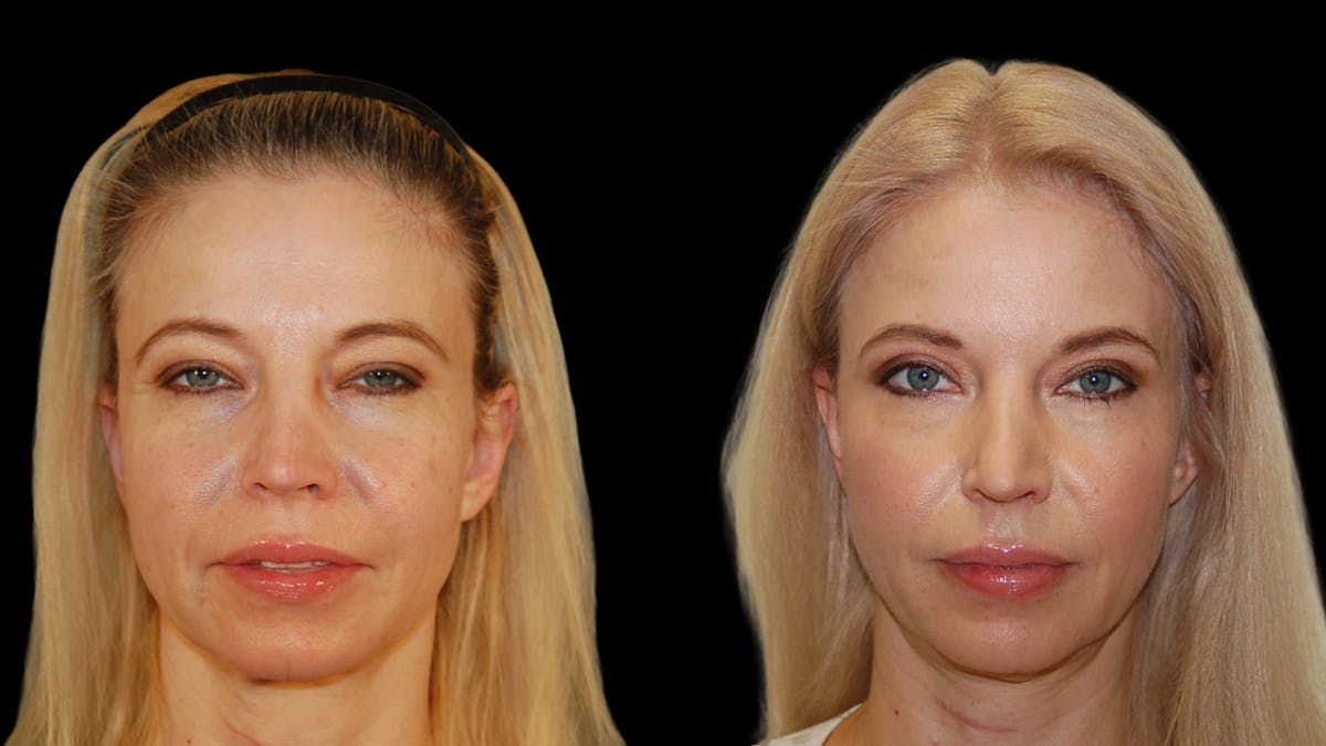 Upper Eyelid Surgery Before & After Gallery - Patient 178013 - Image 1