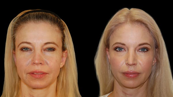 Upper Eyelid Surgery Before & After Gallery - Patient 178013 - Image 1