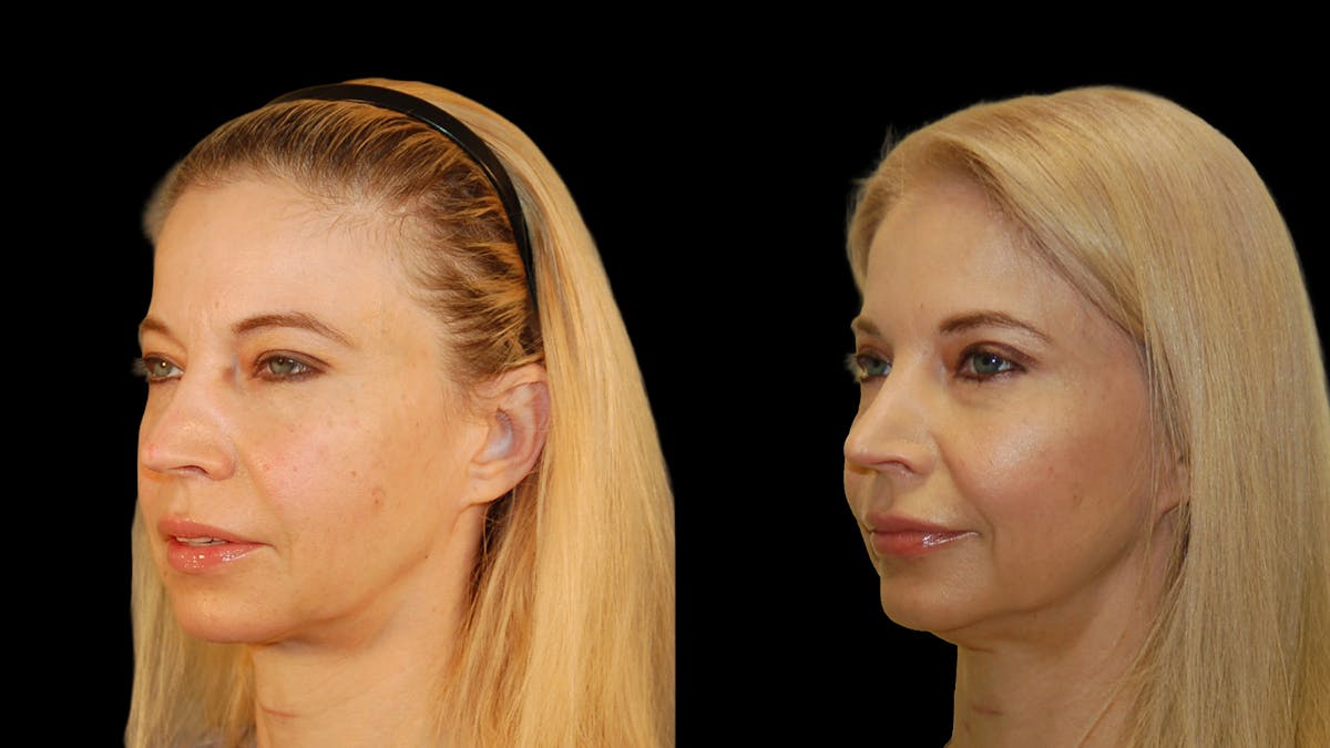 Upper Eyelid Surgery Before & After Gallery - Patient 178013 - Image 2