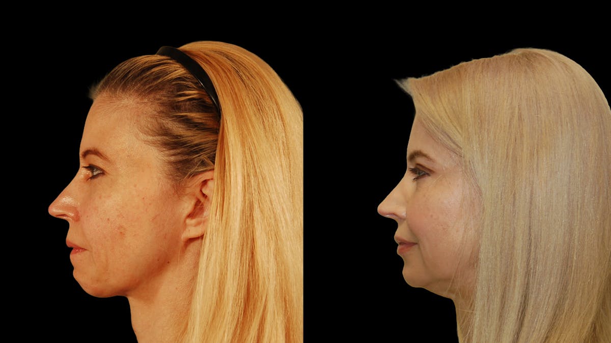 Upper Eyelid Surgery Before & After Gallery - Patient 178013 - Image 3