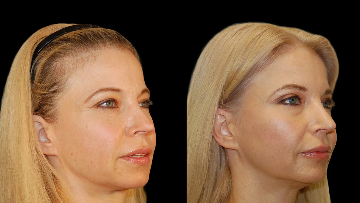 Upper Eyelid Surgery Before & After Gallery - Patient 178013 - Image 4