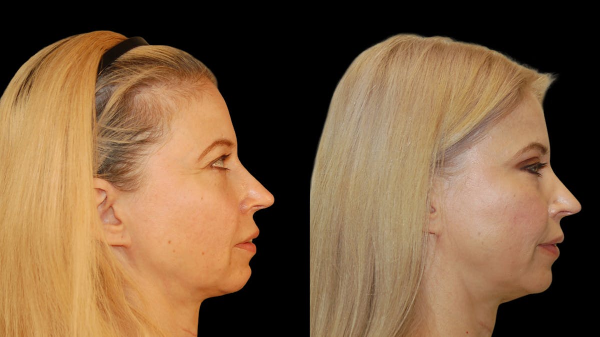 Upper Eyelid Surgery Before & After Gallery - Patient 178013 - Image 5