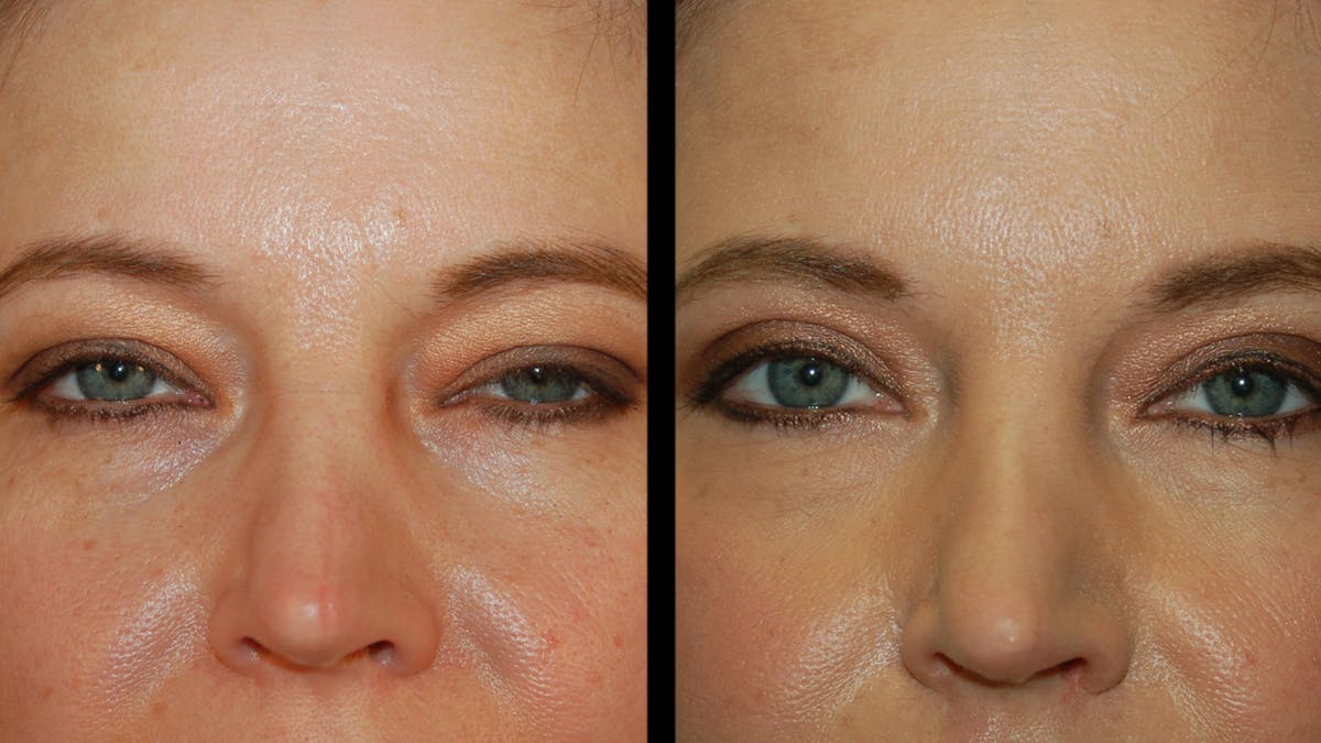 Upper Eyelid Surgery Before & After Gallery - Patient 178013 - Image 6