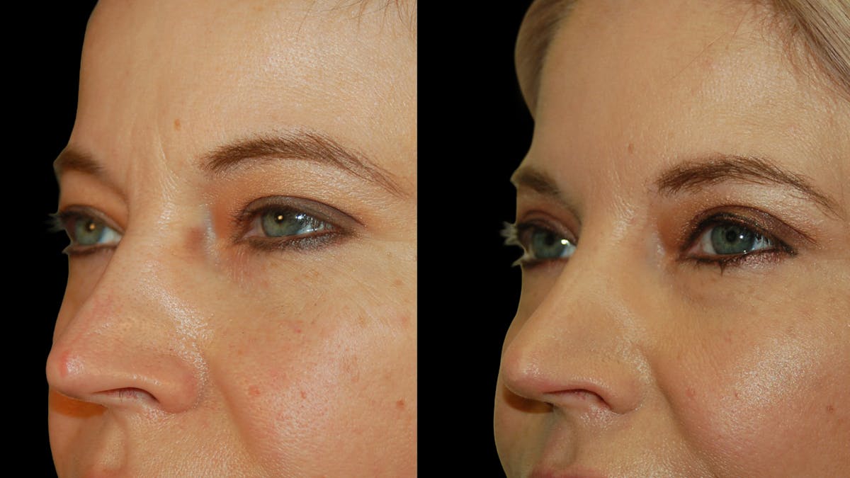 Upper Eyelid Surgery Before & After Gallery - Patient 178013 - Image 7