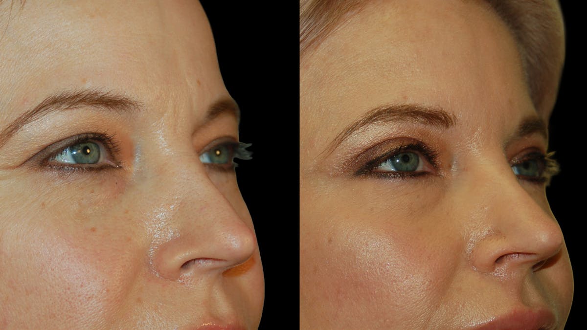 Upper Eyelid Surgery Before & After Gallery - Patient 178013 - Image 8