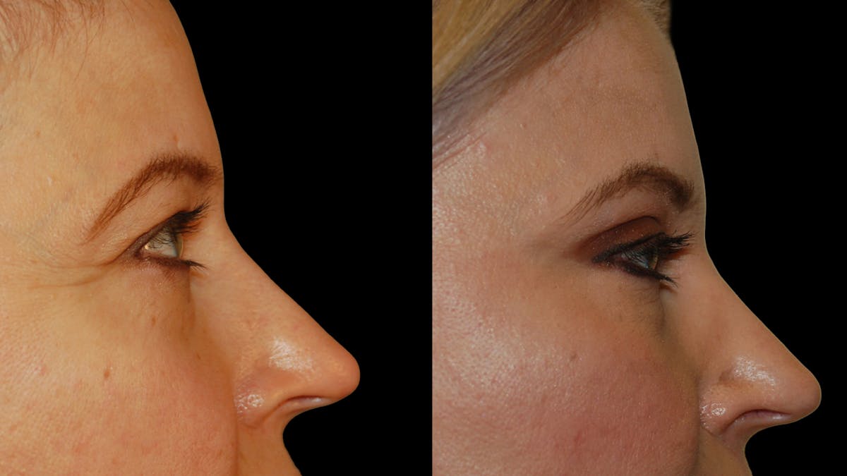 Upper Eyelid Surgery Before & After Gallery - Patient 178013 - Image 9