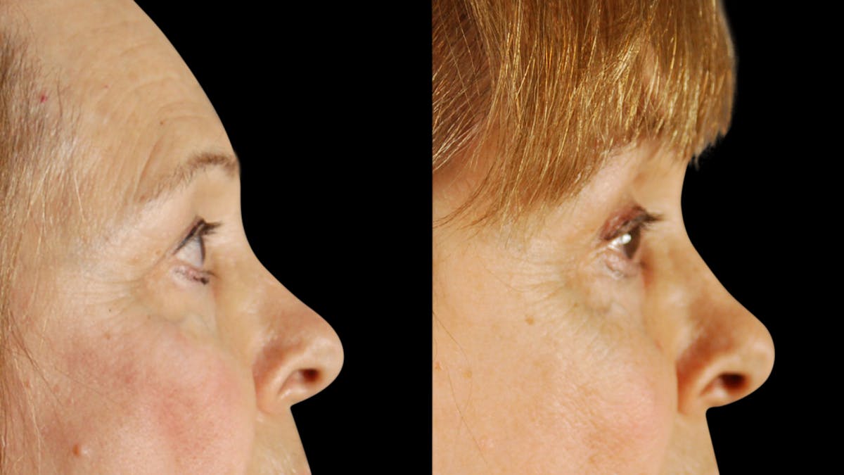 Upper Eyelid Surgery Before & After Gallery - Patient 171756 - Image 3