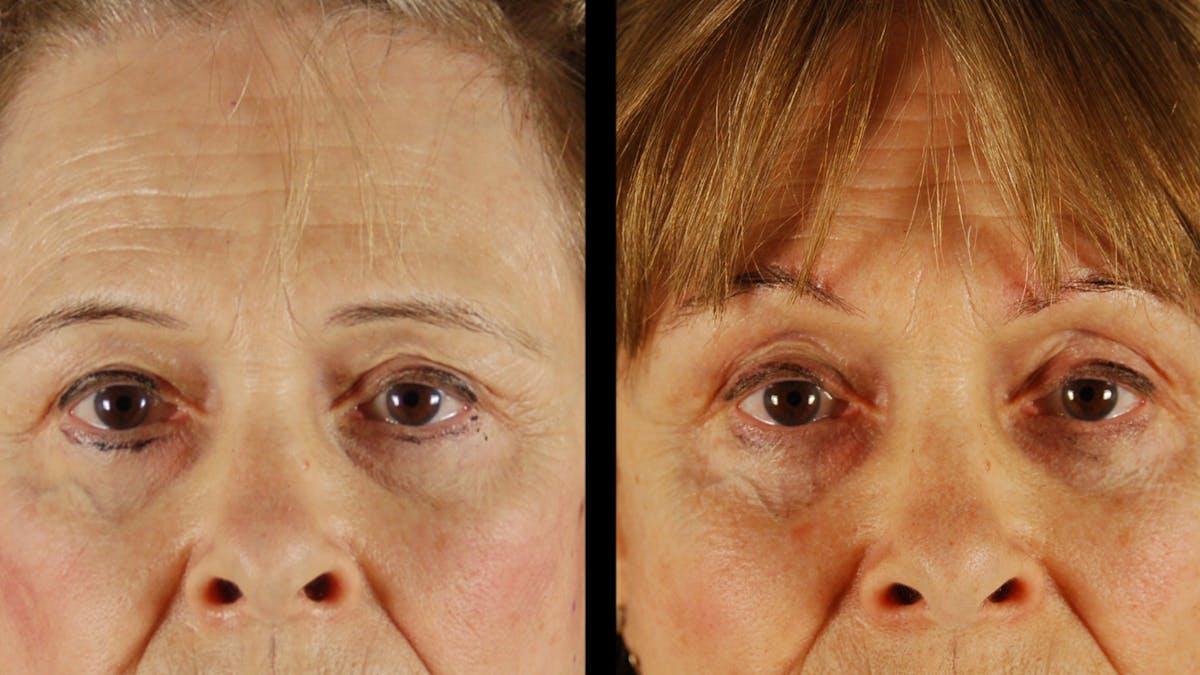 Upper Eyelid Surgery Before & After Gallery - Patient 171756 - Image 4