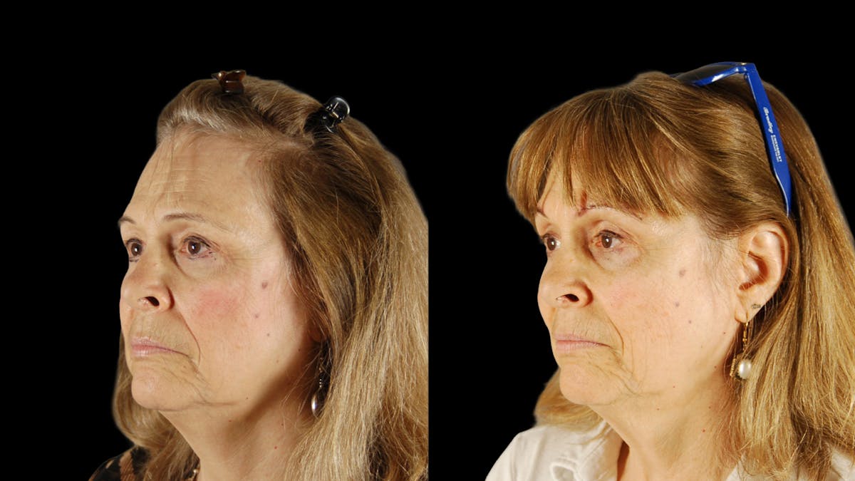 Upper Eyelid Surgery Before & After Gallery - Patient 171756 - Image 1