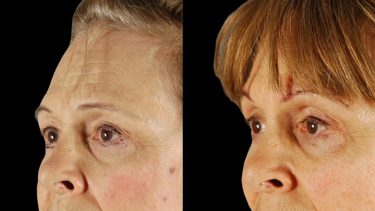 Upper Eyelid Surgery Before & After Gallery - Patient 171756 - Image 5