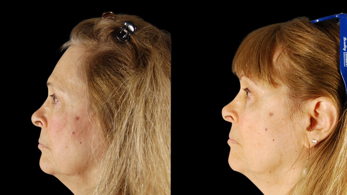 Upper Eyelid Surgery Before & After Gallery - Patient 171756 - Image 2