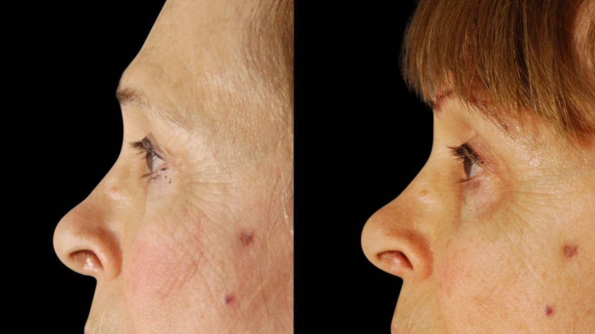 Upper Eyelid Surgery Before & After Gallery - Patient 171756 - Image 6
