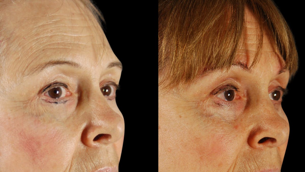 Upper Eyelid Surgery Before & After Gallery - Patient 171756 - Image 7