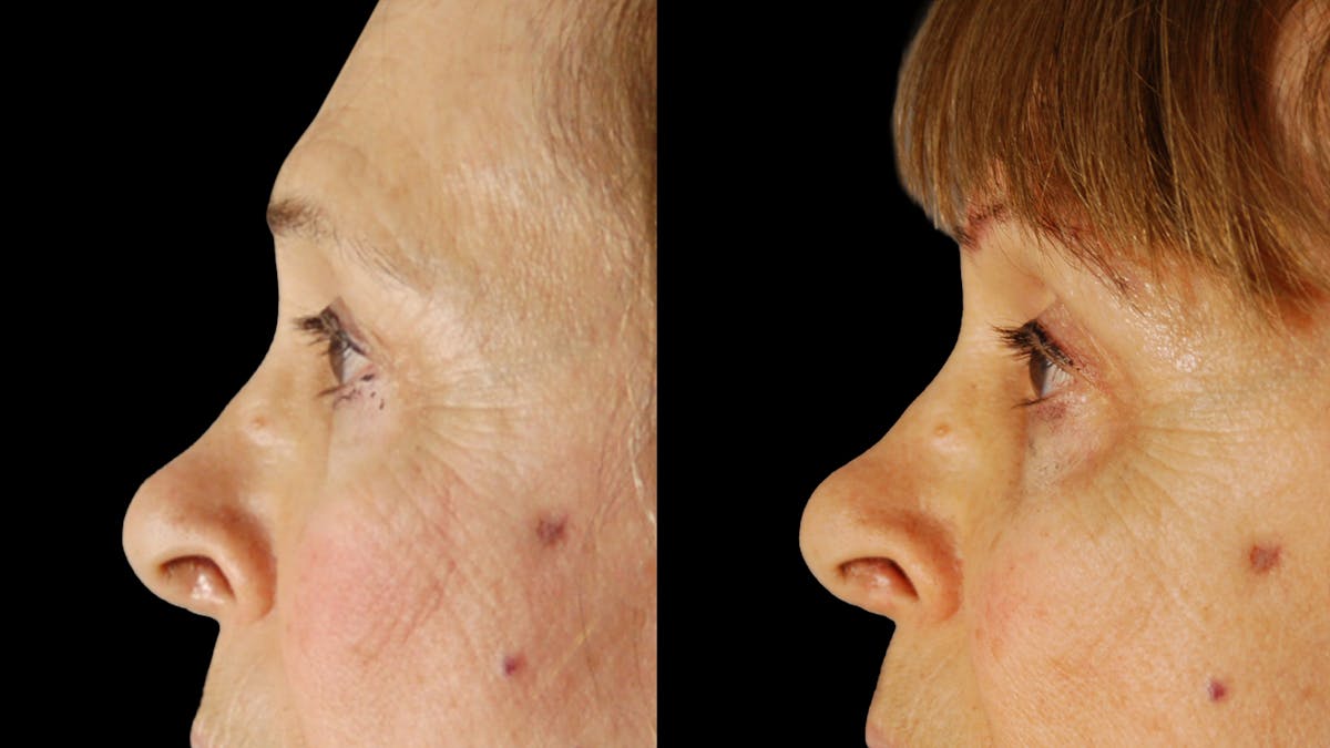 Upper Eyelid Surgery Before & After Gallery - Patient 171756 - Image 8