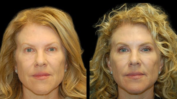 Upper Eyelid Surgery Before & After Gallery - Patient 378435 - Image 1