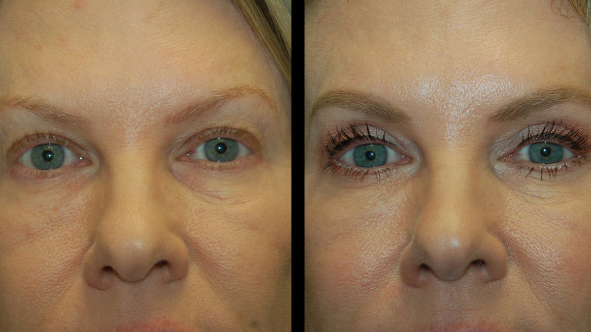 Upper Eyelid Surgery Before & After Gallery - Patient 378435 - Image 4