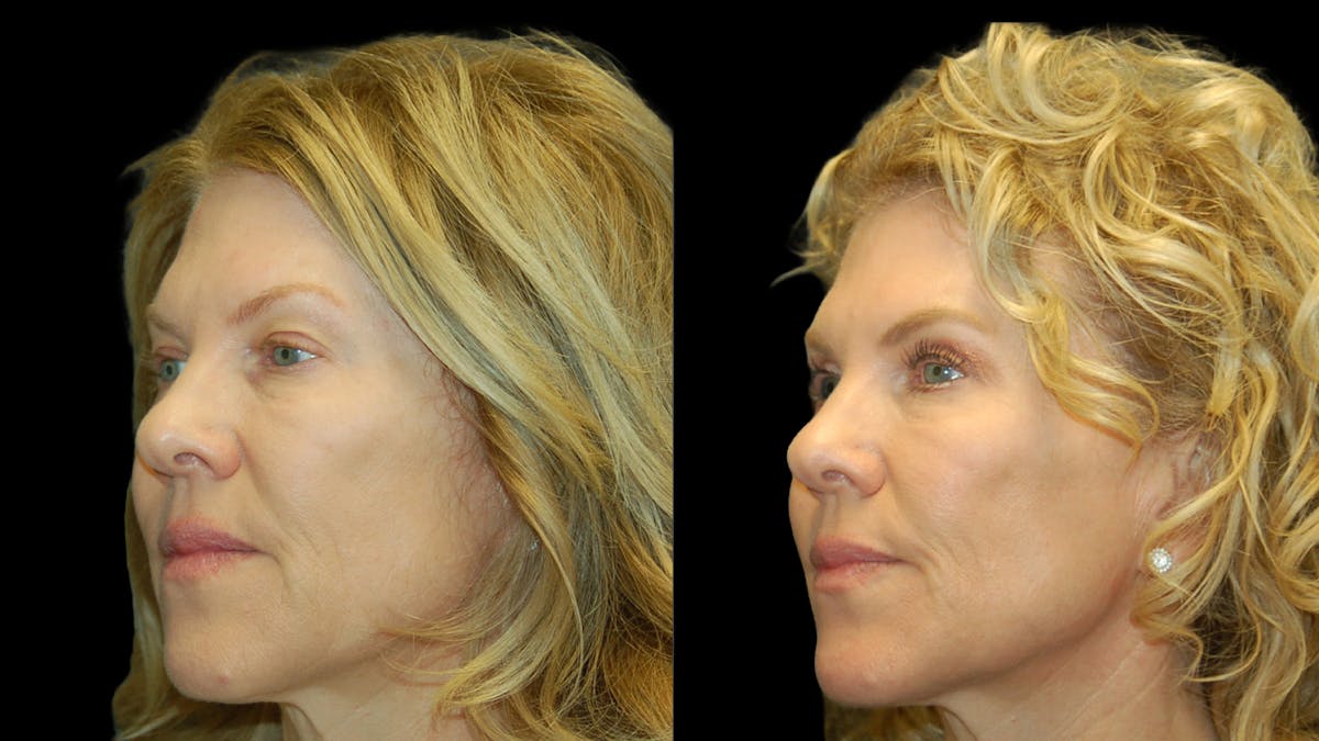 Upper Eyelid Surgery Before & After Gallery - Patient 378435 - Image 2