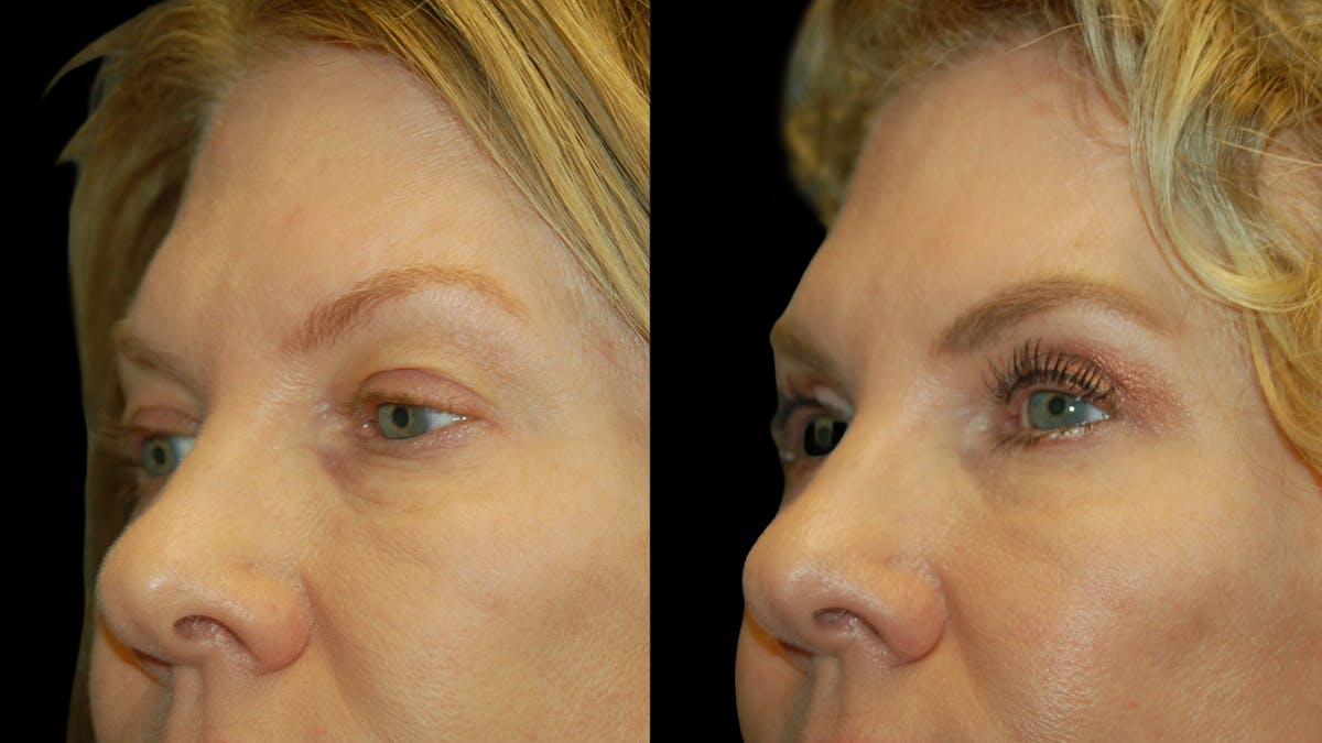 Upper Eyelid Surgery Before & After Gallery - Patient 378435 - Image 5