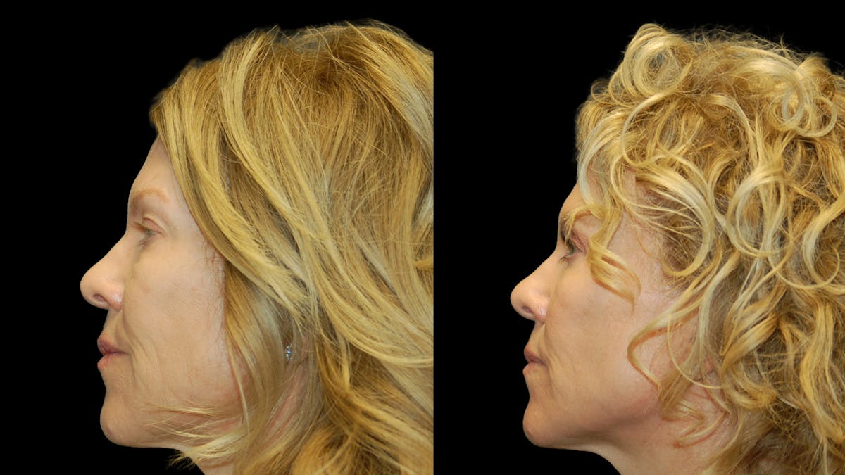 Upper Eyelid Surgery Before & After Gallery - Patient 378435 - Image 3