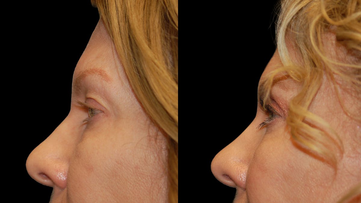 Upper Eyelid Surgery Before & After Gallery - Patient 378435 - Image 6