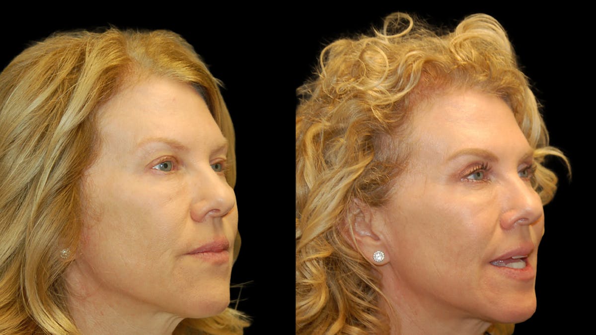 Upper Eyelid Surgery Before & After Gallery - Patient 378435 - Image 7