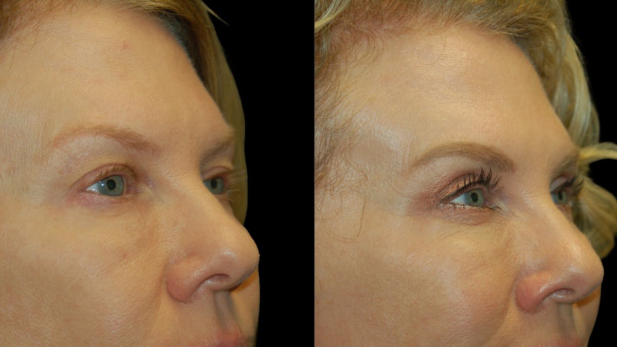 Upper Eyelid Surgery Before & After Gallery - Patient 378435 - Image 8