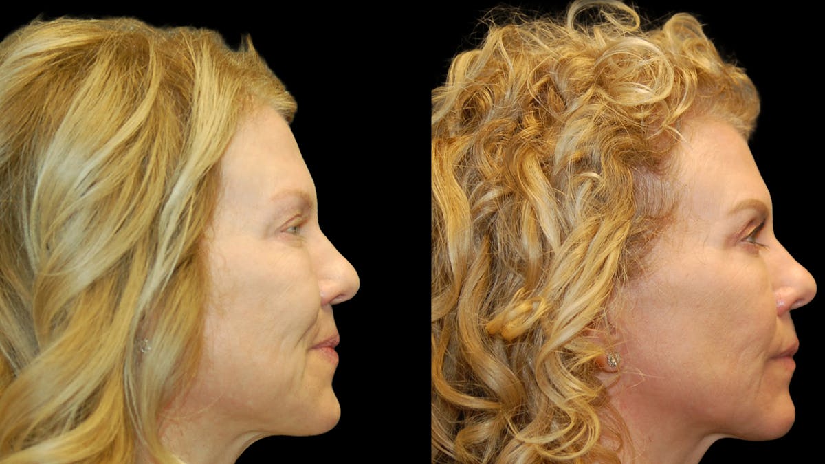 Upper Eyelid Surgery Before & After Gallery - Patient 378435 - Image 9