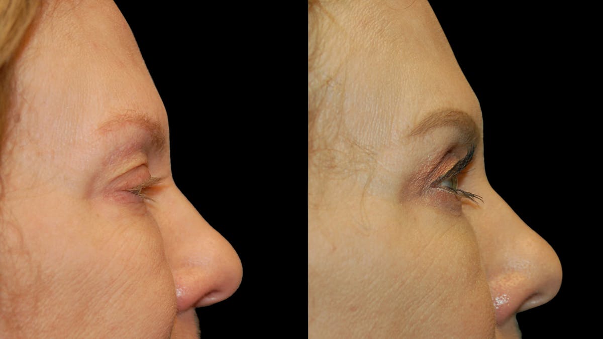 Upper Eyelid Surgery Before & After Gallery - Patient 378435 - Image 10